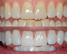 laser teeth whitening east grinstead